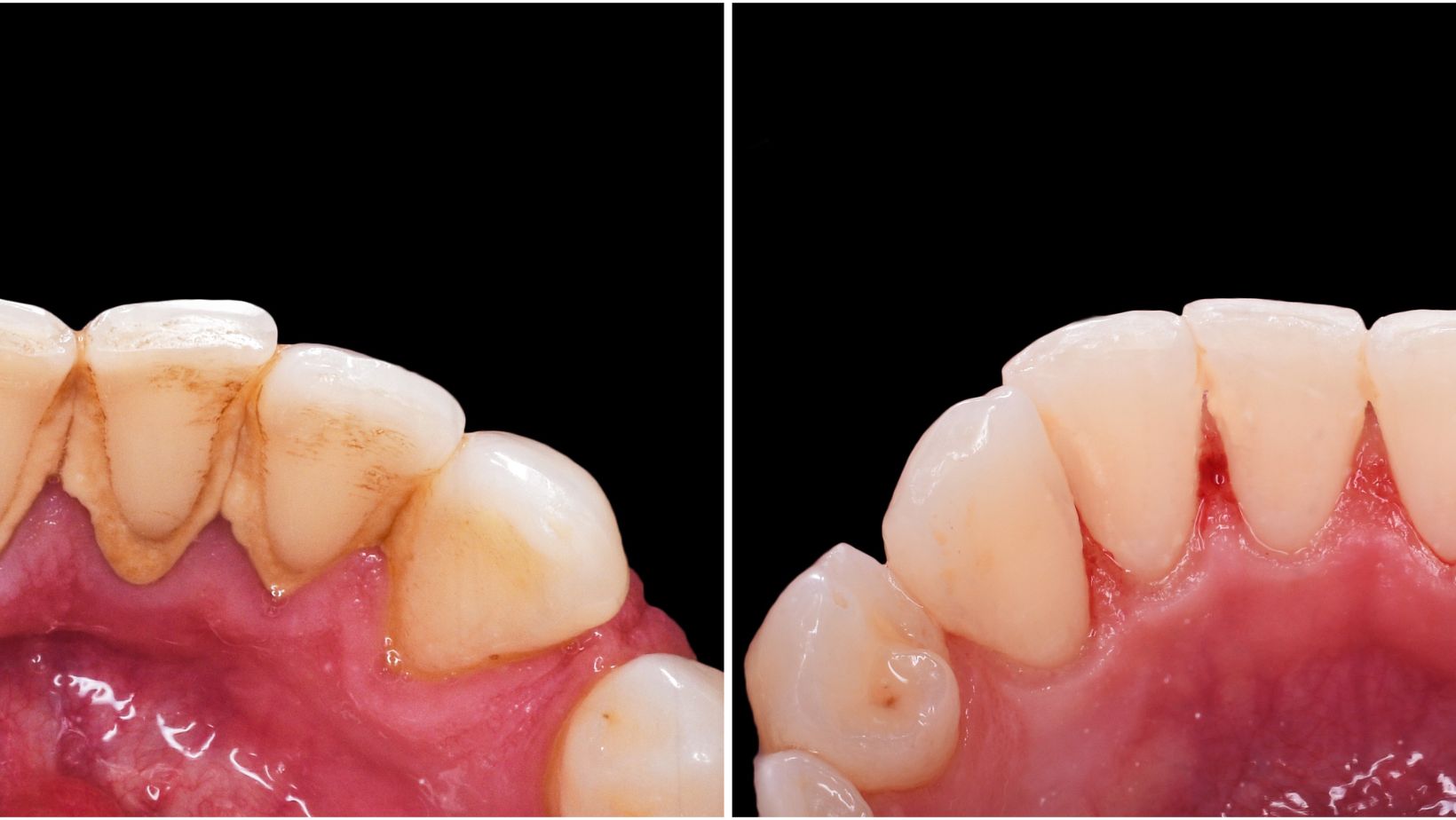 Detartraj Dan Stomatologie Sector 1